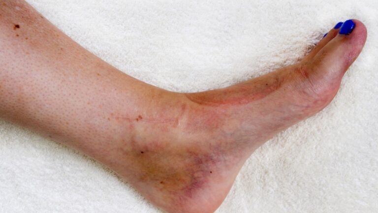 Ankle Broken Or Sprained How To Identify Your Ankle Injury