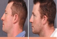 Photo of Men Can Change Their Face Features With These Procedures