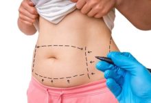 Photo of Tummy Tuck in Los Angeles: Plastic Surgery Procedures