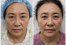 Photo of Amazing Procedures That Can Enhance Your Looks