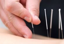 Photo of THE PROCESS OF ACUPUNCTURE- REGENERATE YOUR NATURAL HEALERS