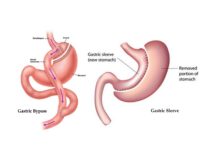 Photo of Gastric Bypass vs. Gastric Sleeve
