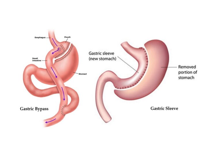 Gastric Bypass vs. Gastric Sleeve