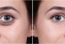 Photo of Get A Refreshed And Revitalised Look With These Tear Trough Fillers