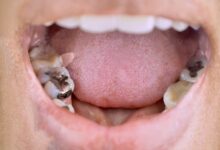 Photo of Tooth Fillings: What are the Different Types?