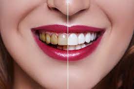 Photo of Dental Veneers? What Types of Problems Can They Fix?