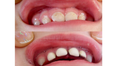 Photo of Tooth Crowns: All You Need to Know
