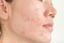 Photo of What Causes Acne Scars and The Best Acne Treatments to Prevent Them
