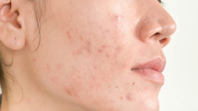 Photo of What Causes Acne Scars and The Best Acne Treatments to Prevent Them