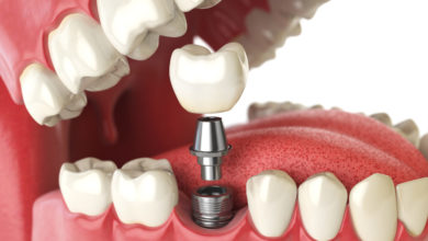 Photo of Tooth Implants: Are They Safe?