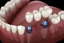 Photo of How to Prepare for Your Dental Implant Procedure