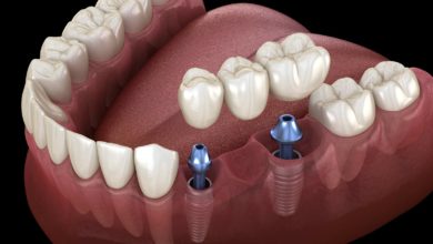 Photo of How to Prepare for Your Dental Implant Procedure