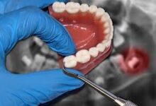 Photo of What Should You Know About Wisdom Teeth