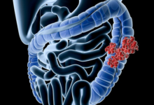Photo of Everything You Need to Know About Colon Cancer
