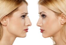 Photo of What Is Nose Augmentation, And What Are Its Advantages