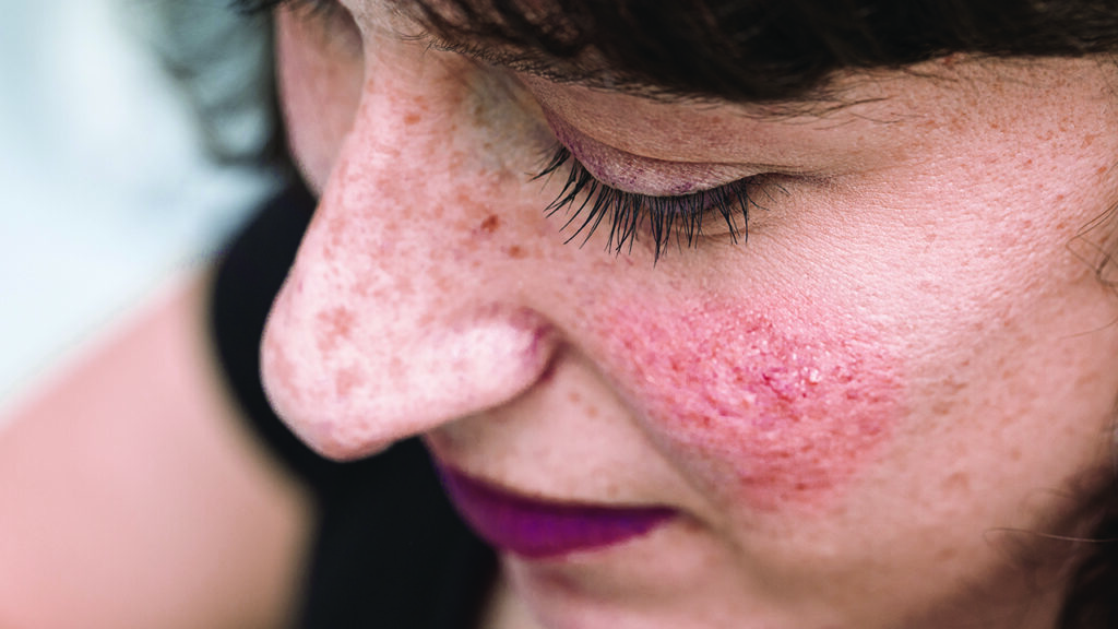 All You Need To Know About Rosacea 9354