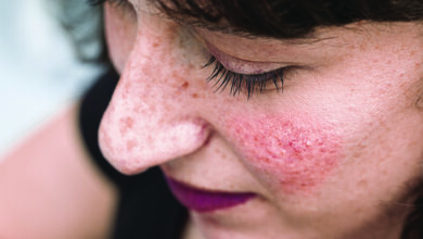 Rosacea