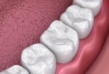 Photo of Benefits Of Opting For Dental Filling
