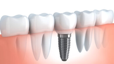 Photo of Choose Dental Implants For Teeth Replacement: Top 5 Reasons