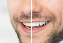 Photo of Is Teeth Whitening Safe And Appropriate For Teenagers? 