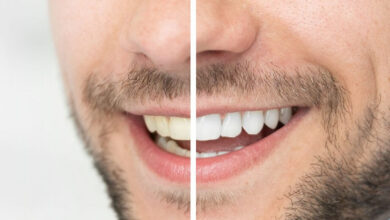 Photo of Is Teeth Whitening Safe And Appropriate For Teenagers? 