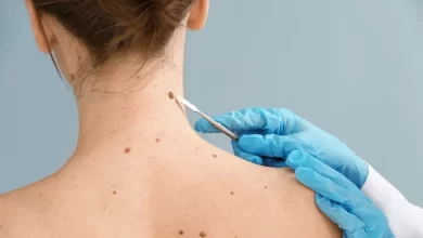 Photo of Why regular skin checks are essential for mole removal?