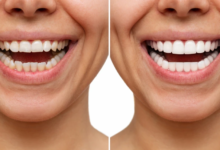 Photo of Porcelain Veneers Brisbane: Enhance Your Smile with Barrett Street Dental