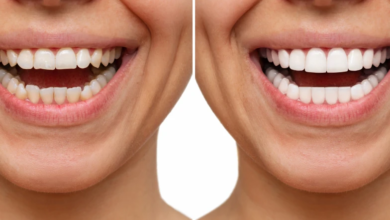 Photo of Porcelain Veneers Brisbane: Enhance Your Smile with Barrett Street Dental