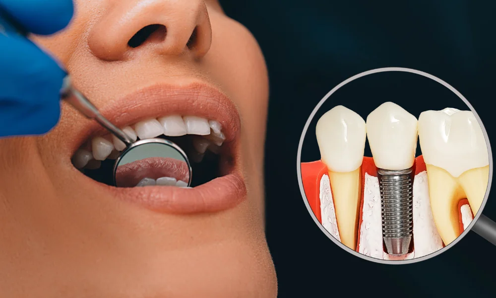 Dental Implant